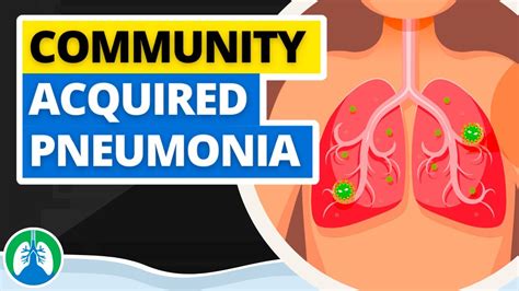 community acquired pneumonia adalah